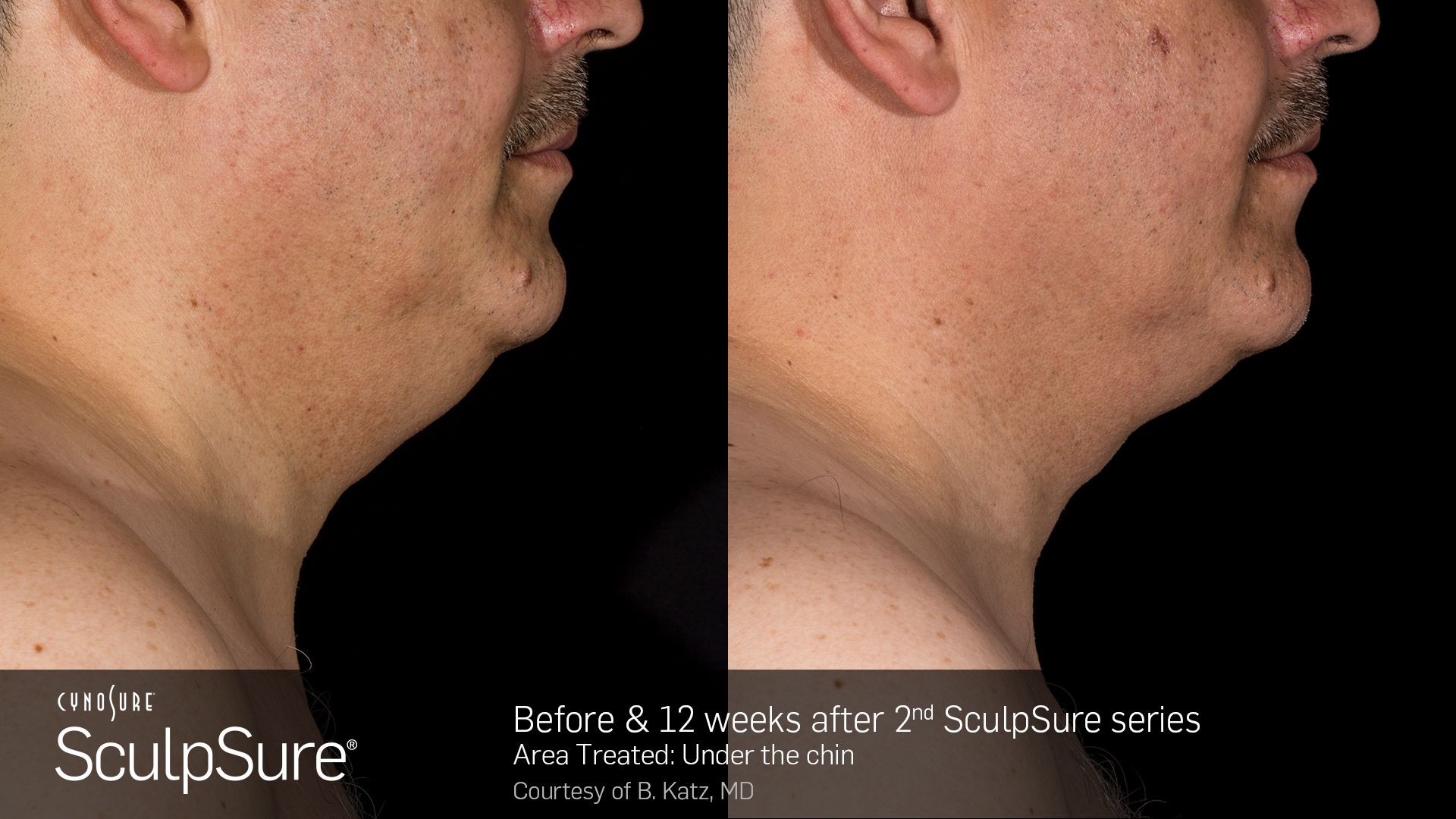 Sculpsure® Submental Before And After Photos Gallery Dr Kohn